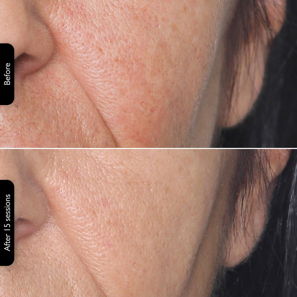 3-in-1 RF Face & Neck Skin Tightening Device