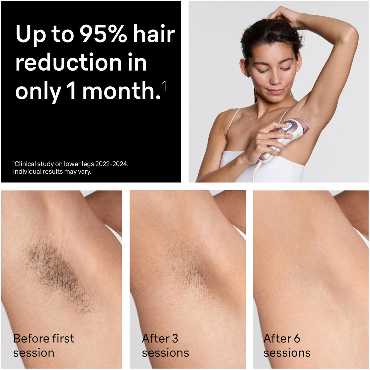 Smart IPL Hair Removal Device with App