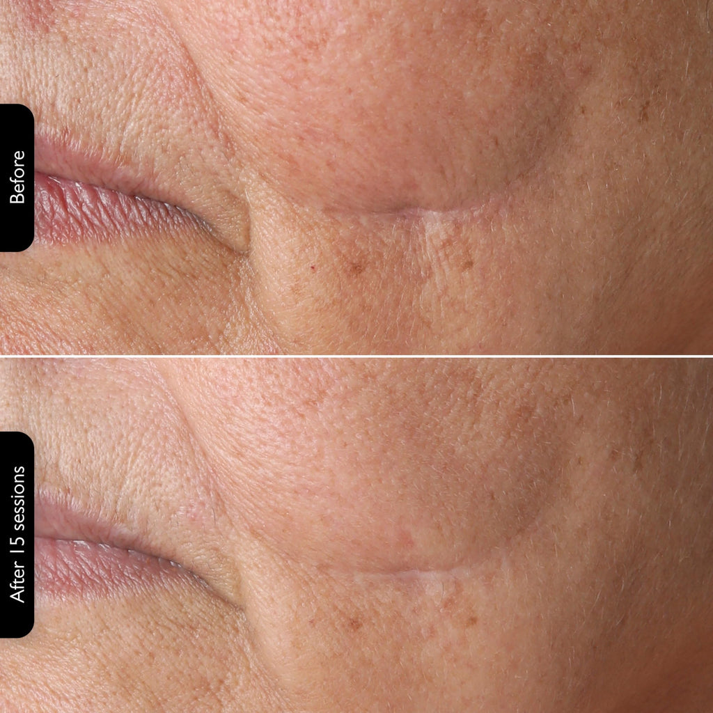 3-in-1 RF Face & Neck Skin Tightening Device