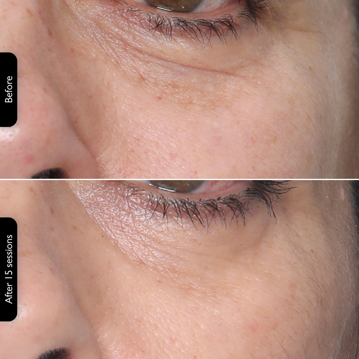 3-in-1 RF Face & Neck Skin Tightening Device